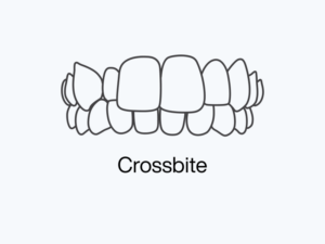 Crossbite.png