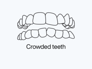 Crowded Teeth.png