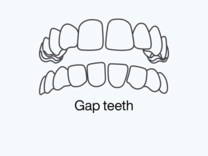 Gap Teeth.png
