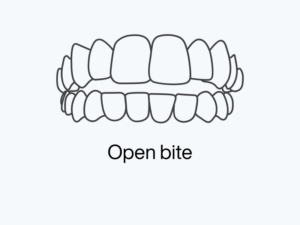 Open Bite.png