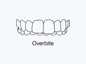 Overbite.png