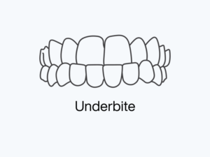 Underbite.png